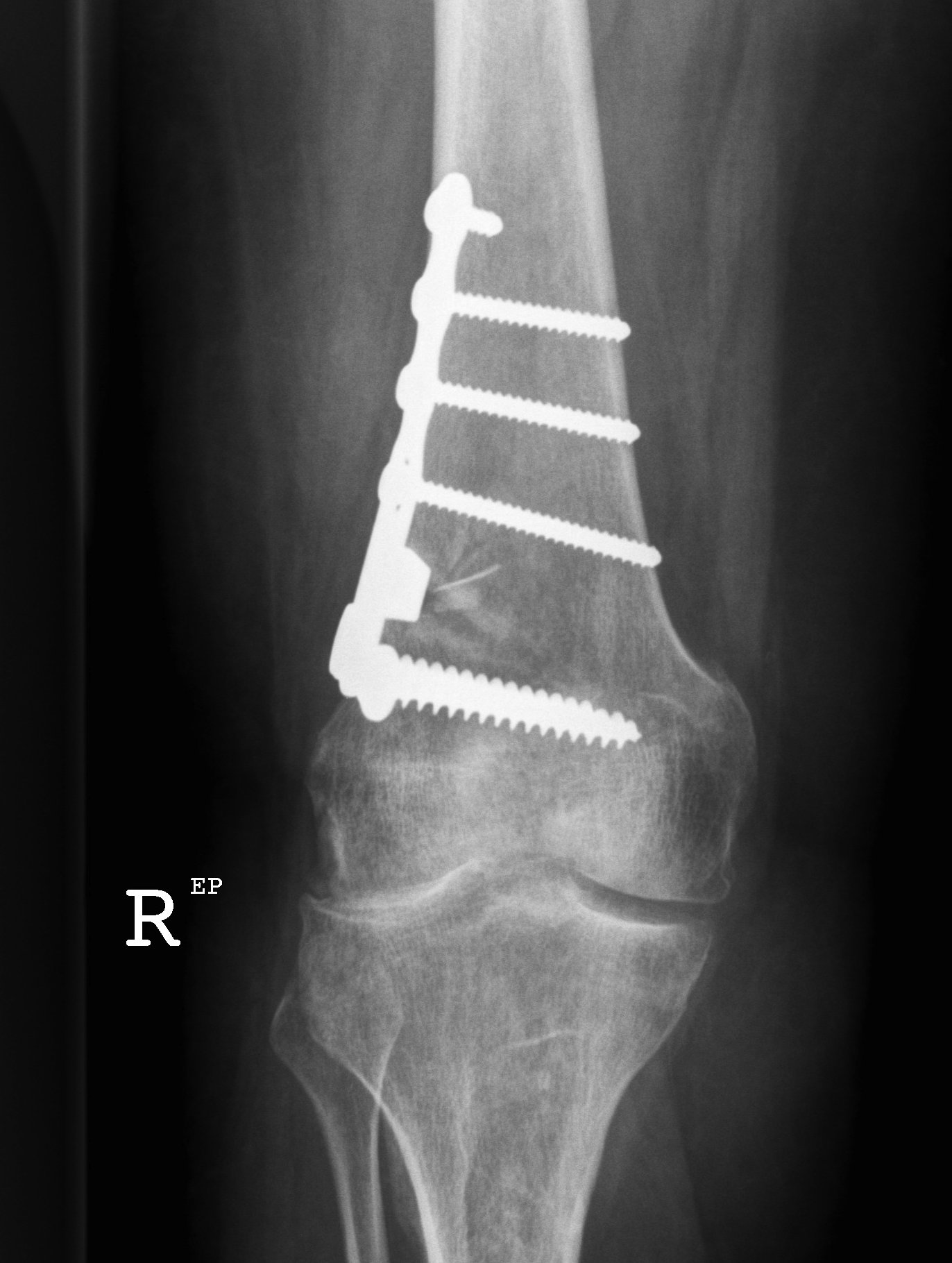 Lateral Distal Femoral Osteotomy